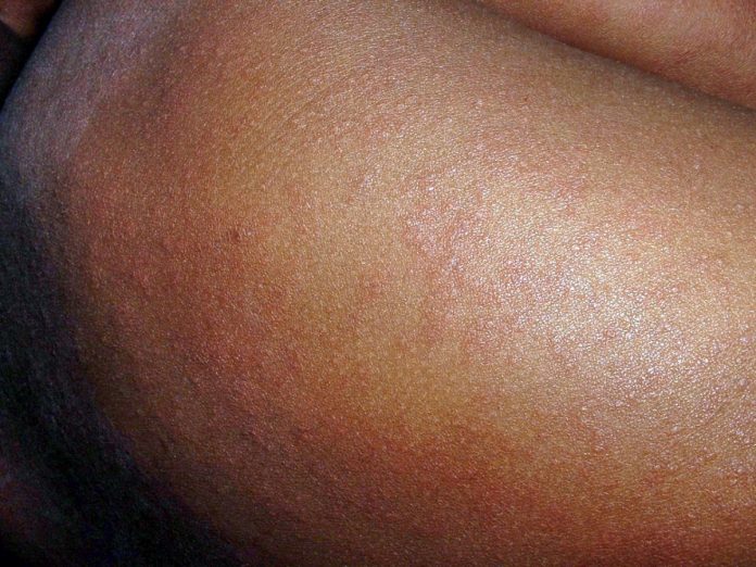 measles-648479